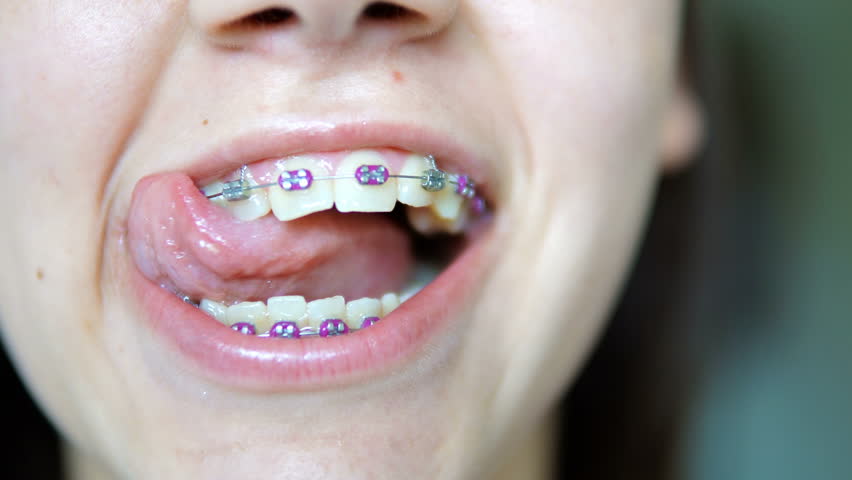 Young Girls With Braces On Teeth